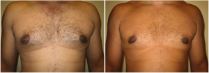 gynecomastia-surgeon-long-island-before-after-7-1