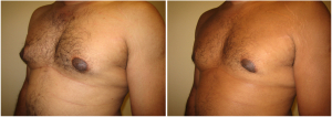 gynecomastia-surgeon-long-island-before-after-7-3