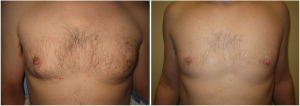 gynecomastia-surgeon-long-island-before-after-8-1