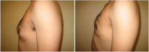 gynecomastia-surgeon-long-island-before-after-9-2