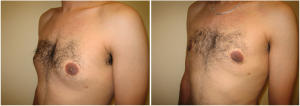 gynecomastia-surgeon-long-island-before-after-9-3