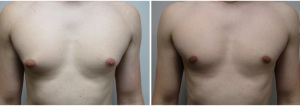 gynecomastia-surgeon-long-island-before-after-20-1