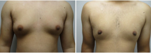 gynecomastia-surgeon-long-island-before-after-29-1