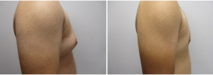 gynecomastia-surgeon-long-island-before-after-29-2