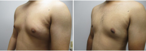 gynecomastia-surgeon-long-island-before-after-29-3