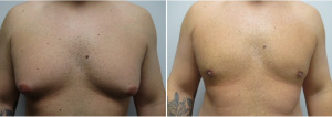gynecomastia-surgeon-long-island-before-after-40-yo-6-months-post-op-1-1