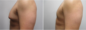 gynecomastia-surgeon-long-island-before-after-40-yo-6-months-post-op-1-2