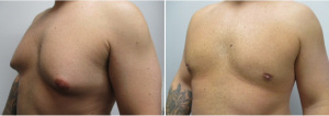 gynecomastia-surgeon-long-island-before-after-40-yo-6-months-post-op-1-3