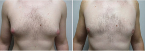 gynecomastia-surgeon-long-island-before-after-25-yo-3-months-post-op-1-1