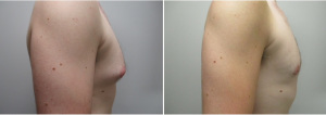 gynecomastia-surgeon-long-island-before-after-25-yo-3-months-post-op-1-2
