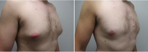 gynecomastia-surgeon-long-island-before-after-25-yo-3-months-post-op-1-3