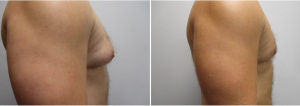 1_gynecomastia-surgeon-long-island-before-after-31-yo-6-months-post-op-1-2