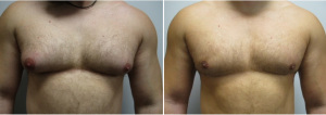 gynecomastia-surgeon-long-island-before-after-31-yo-6-months-post-op-1-1