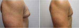 gynecomastia-surgeon-long-island-before-after-31-yo-6-months-post-op-1-2