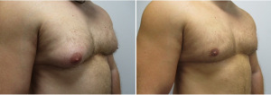 gynecomastia-surgeon-long-island-before-after-31-yo-6-months-post-op-1-3